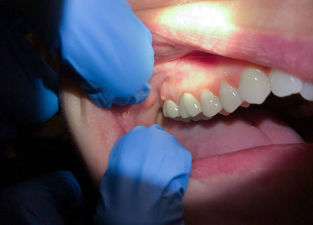 Best Emergency Dental Care for Broken or Chipped Teeth in Agler Estates, FL